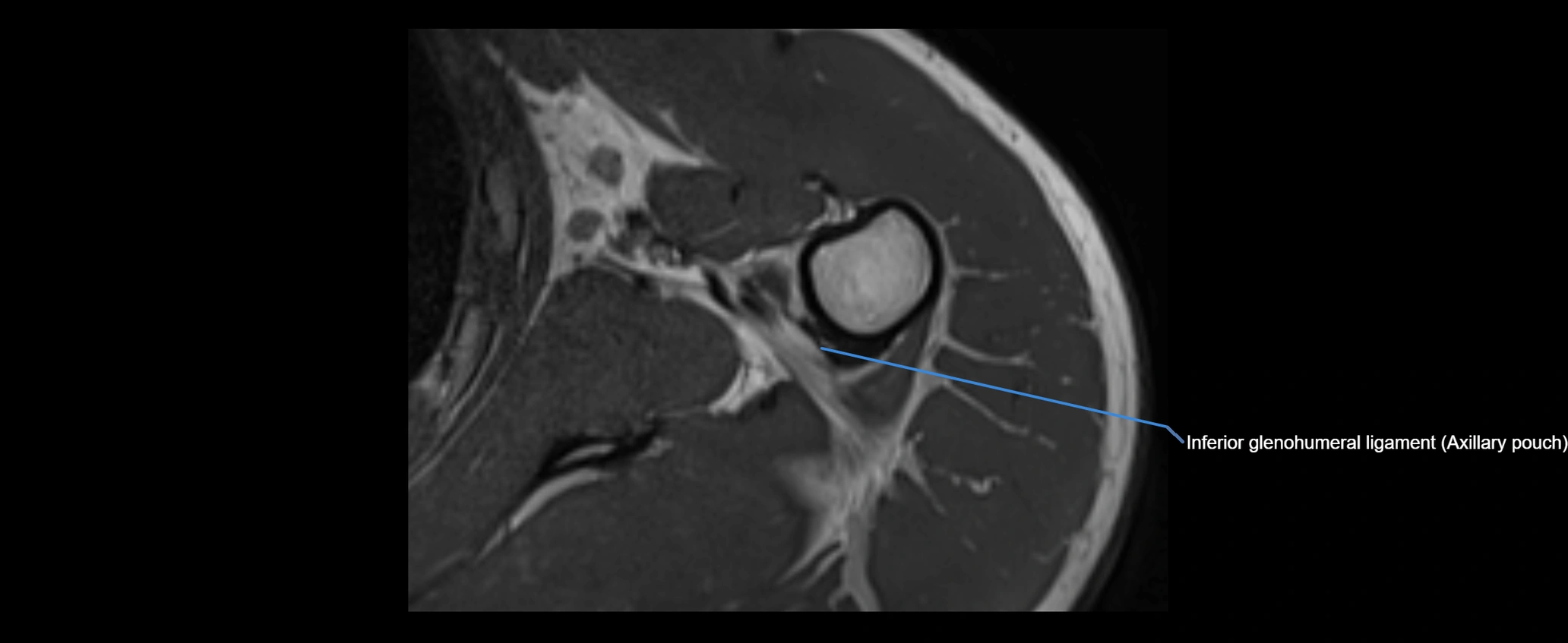 shoulder ligaments axial 3d 3t mri image-img-00005-00097.webp